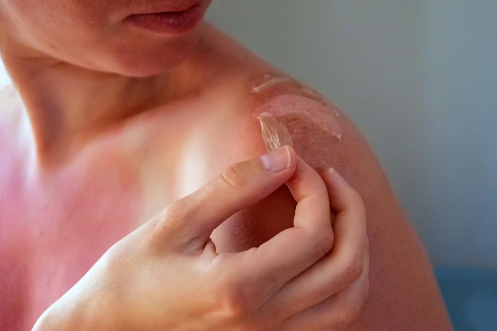 Sunburn Rescue Pack & Kinga ya Jua